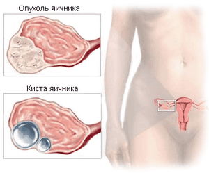 Онкология матки и яичников:признаки,симптомы,лечение,удаление